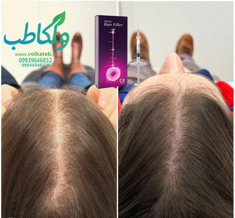 هیرفیلر دکتر سی وای جی ولکا طب 09939646852  پخش عمده ژل و بوتاکس
