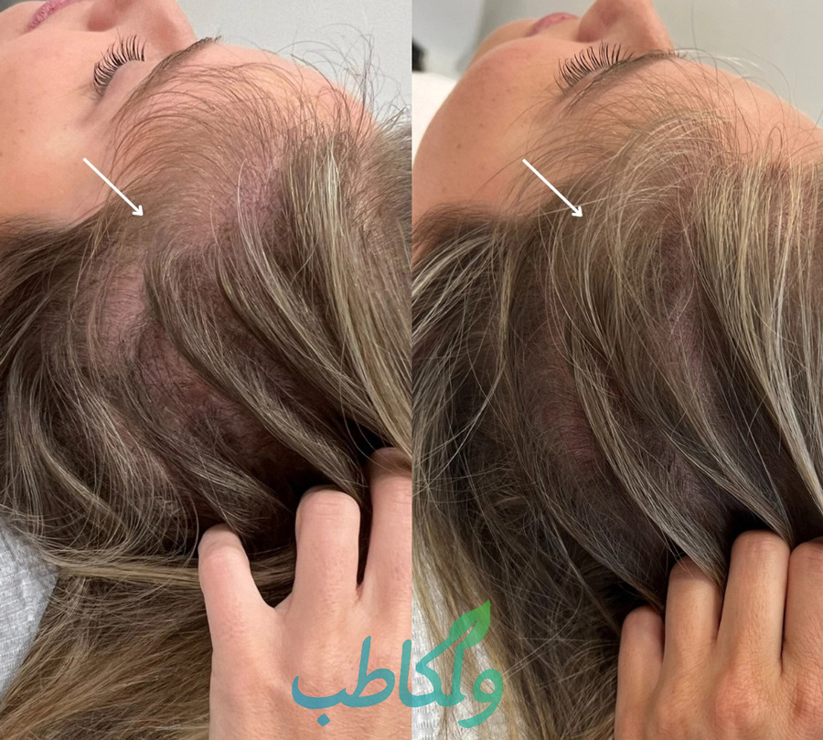 هیرفیلر دکتر سی وای جی ولکا طب 09939646852  پخش عمده ژل و بوتاکس